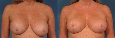 55 year old breast implant revision - This 55 year old woman had prior breast augmentation with silicone implants in the 1980s above the muscle. She developed bad capsular contractures of the breasts, breast drooping and rupture of the right breast implant. The patient underwent breast implant exchange, removal of the hardened and thickened capsule, removal of the free silicone gel, change of pocket to under the muscle, placement of Strattice acellular dermal graft to the lower pole of the breast and breast lift. Her implants remain soft, her nipples are in good position and the patient is extremely satisfied. Surgeon: Dr. Hasen Patient Age: 55 Height: 5'8 Weight Before: 165 lbs Patient Gender: Female Implant Size Left: 325 cc Implant Size Right: 300 cc Breast Incision Type: Vertical Chest Measure Before: 38 inches Chest Measure After: 38 inches Cup Size Before: D Cup Size After: D