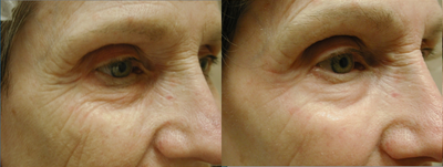 Madonna Lift Procedures  - 
	The Madonna Lift is a new type of laser eyelift. It utilizes an innovative fractional CO2 laser which creates tiny microscopic channels in the tissue so that new collagen can grow in to rejuvenate the skin. It dramatically reduces the appearance of dark rings and wrinkles while tightening eyelid skin and elevating drooping eyebrows.
