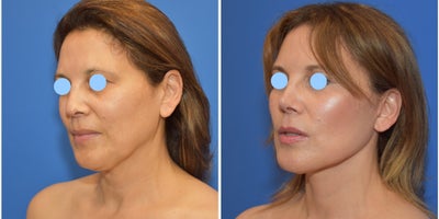 Woman treated with Neck Lift, Facelift, Rhinoplasty - Woman treated with Facelift