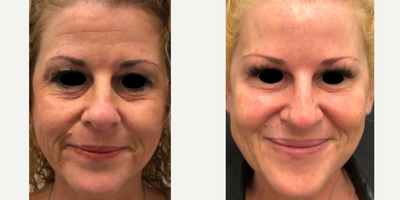 45-54 year old female treated with SkinPen/Botox - This patient had the intention of achieving smoother skin texture with less expression lines. Shes been treated on 3 different occasions with Botox/Xeomin and complemented them with just one SkinPen Microneedling session.
