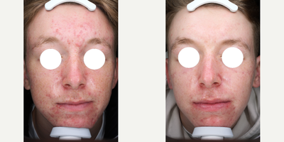 25-34 year old man treated with LED Light Therapy - Permanent changes in the skin will start to occur over a course of treatments, in some cases clients can expect immediate improvement in skin tone, hydration and overall radiance.