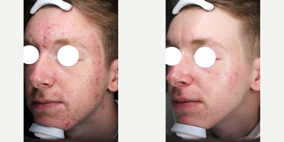 25-34 year old man treated with LED Light Therapy - While we often associate light exposure with skin ageing and damage, light also has many positive influences on the body. It helps us produce vitamin D and provides energy and serotonin and can also accelerate our skins natural repair processes. The treatment involves exposing the skin to low levels of this beneficial light energy from the visible and infrared part of the light spectrum which energises cellular functions to stimulate various cellular processes with therapeutic effects.