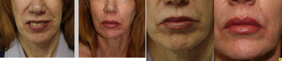 Fat Transfers to the Face to replace Volume - This is a 60 year old patient who comes to us for fat grafting to her face to replace the last volume.&nbsp;