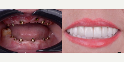 Woman treated with Dental Implants, Smile Makeover - Woman treated with Dental Implants, Smile Makeover