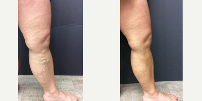35-44 year old woman treated with VenaSeal - This patient had bulging varicose veins in her calf and venous reflux higher in the great saphenous. We used Venaseal and she had incredible results!