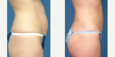 35-44 year old woman treated with Mini Tummy Tuck - post pregnancy bulgminimal skin laxitygreat candidate for mini tummy tuck