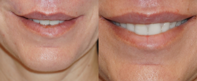 35-44 year old woman treated with Lip Repositioning - This beautiful patient was interested in a revision lip lift after her original procedure addressed her mid upper lip, but did not lift the lateral upper lip. A lift of the lateral upper lip is one of the most difficult areas to address in a lip lift. I performed a modified upper lip lift to address the lateral areas and improve her tooth show at rest. Here she 3 months post procedure.