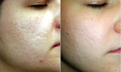 18-24 year old woman treated with eMatrix - Fractional radiofrequency (Sublative or eMatrix) are great options for those wanting low downtime improvements in skin texture/tone, scarring, pigmentation and pores.