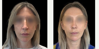 25-34 year old woman treated with Chin Implant, Rhinoplasty - A rhinoplasty performed using a closed scarless preservation rhinoplasty technique combined with a chin implant