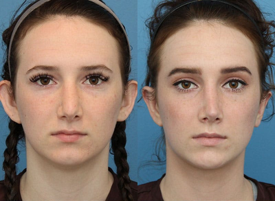 Woman treated with Revision Rhinoplasty - Woman treated with Revision Rhinoplasty