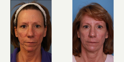 35-44 year old woman treated with MiXto Laser - MiXto Laser Procedure