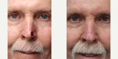 76 year old man 3 months after nose reconstruction from Mohs Surgery - 76 year old man underwent reconstruction of his nose following Mohs Surgery for removal of a squamous cell carcinoma (SCC) skin cancer. Photos are at time of surgery and 3 months post-op.