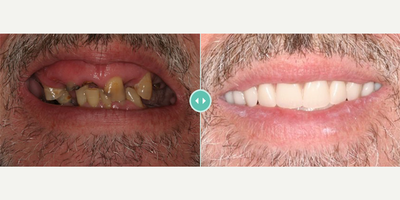 Man treated with Dental Implants - Man treated with Dental Implants