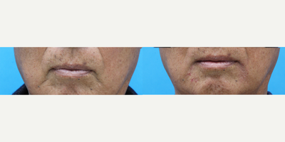 35-44 year old woman treated with Restylane, Restylane Defyne, Voluma, Vollure, Dermal Fillers - Dermal Fillers