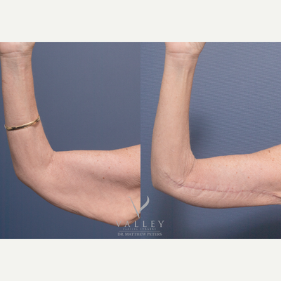 45-54 year old woman treated with Arm Lift, Body Lift, Breast Reduction - Belt lipectomy and bilateral brachioplasty