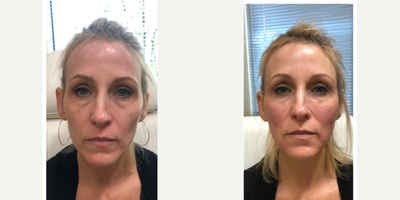 45-54 year old woman treated with Bellafill - Patient had Bellafill injected in her temples, outer portions of face, Versa injected in tear troughs. After picture taking immediately after injections.