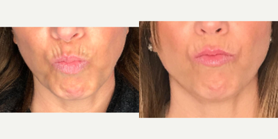 Vollure for this 45 Year Old Woman - This 45-year old female had Vollure injected into her upper lip and perioral lines, as well as Botox injected into the muscles of the lower face.