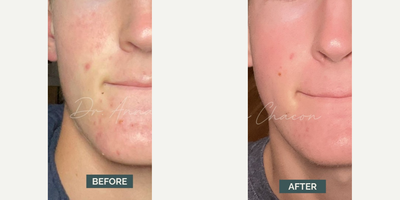Man treated with Accutane - Man treated with Accutane