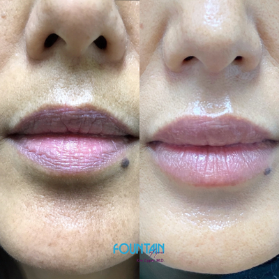 55-64 year old woman treated with SkinMedica - This is the perfect example of consistent skin care. Consistent use of our SkinMedica products, CO2 Laser, and monthly facials.