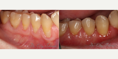 25-34 year old woman treated with Gum Graft - Female patient with severe recession and sensitivity on lower right teeth.&nbsp; Tissue was harvested from the palate to cover the exposed roots.