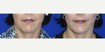 Woman treated with Chin Liposuction, Facelift, Neck Lift, CO2 Laser - This patient was concerned about the crepiness of the skin around her neck and the sagging jowls in her lower face. In order to address her concerns, we performed the FaceologyLIFT to help lift her neckline, tighten her skin, and sculpt her jawline.Two months after surgery, she shows minimal scarring, leaving a subtle and natural result.