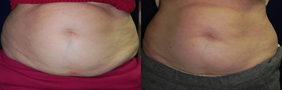 Vanquish Non Invasive Fat Reduction to Abdomen - Patient sought out a non invasive treatment for fat reduction in the waist.   The patient showed fat loss in the abdomen and waist after 4 Radio Frequency Vanquish treatments.
