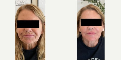 55-64 year old man treated with RHA Collection Fillers, Dysport, Sculptra - For this patirent 40 units of dysport and 2 vials of Scultpra was used during the 1st seating. During second seating, 2 vials of sculptra. Temples, cheeks, NLF, chin shadowing. 4 syringe face rejuvenation using RHA was used for the third seating to achieve these amazing results!