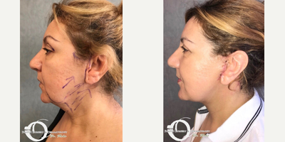 45-54 year old woman treated with Neck Lift - Upper eyelid surgery, face and neck lift