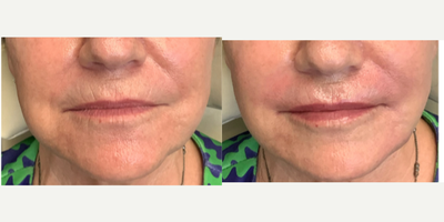 65-74 year old woman treated with Dermal Fillers - 67 y.o. female - c/o of fine lines above and around mouth (smoker's lines/lipstick lines). She did not want botox in that area due to side effects (difficulty speaking). She has had lip fillers in past but wanted the vertical lines above the lips to be smoothed out. Using RHA1 (Redensity) with a micro-cannula - the wrinkles were carefully placed and the adhesions subcised for a great result with no bruising or swelling. The procedure was painless and the patient was very pleased.