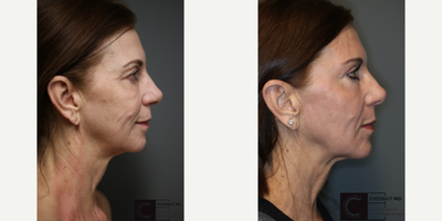 Silhouette Soft - Laser treatment with a lift.