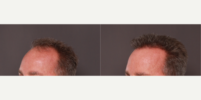 55-64 year old man treated with Hair Transplant, FUE Hair Transplant, Alastin Skincare - 2000 graft hair transplant