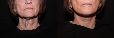Laser Fractional Resurfacing (Perioral) - 
	Laser Fractional Resurfacing (Perioral)

