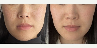 Freckle removal on Japanese skin - Los Angeles - Patient is a young Japanese female that was concerned about the amount of freckling she was developing and wanted her to skin to be more clear.  This is after one (1) Palomar q-switched laser treatment.