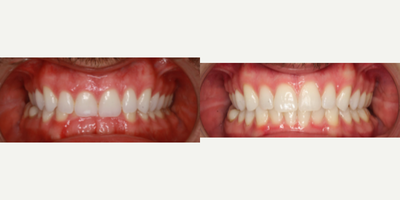 45-54 year old man treated with InBrace - This patient had a severe deepbite with minor crowding, both addressed and fixed in a year and a half using upper and lower InBrace.
