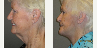 70+ year old woman treated with Lifestyle Lift - This healthy and active grandmother presented for evaluation of her turkey neck and drooping jawline.  After thorough consultation we decided together to proceed with a Lifestyle Lift.  This procedure is, in essence, a lower SMAS facelift and necklift performed safely under local anesthesia and mild oral sedation in our office.  She had a quick recovery of approximately one week and returned to her routine in under two week's time.