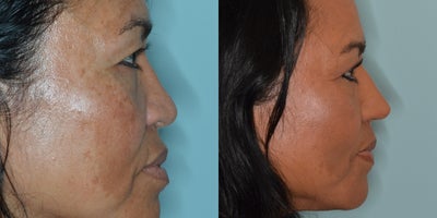 45-54 year old woman treated with Asian Rhinoplasty - Female patient of Asian descent who desired more bridge and tip definition. Primary rhinoplasty techniques included dorsal augmentation, tip grafting, and alar base reductions.
