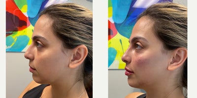 25-34 year old woman treated with Cheek Augmentation - Chin, cheek, undereye and lip augmentation with dermal fillers.
