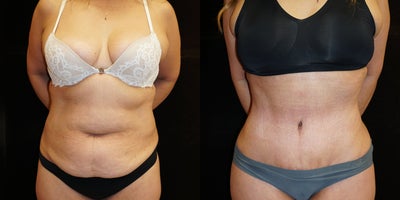55-64 year old woman treated with Diastasis Recti Repair - Tummy tuck with fantastic before and after results!