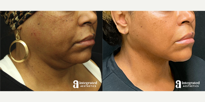 55-64 year old woman treated with AccuTite - This patient had concerns of heaviness in the lower face, neck and chin area. She underwent Accutite to the lower face and neck to reduce facial volume and define the jawline. Patient also received Botox to the masseters for additional facial slimming. After photo is 10 months post procedure.