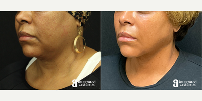 55-64 year old woman treated with AccuTite - This patient had concerns of heaviness in the lower face, neck and chin area. She underwent Accutite to the lower face and neck to reduce facial volume and define the jawline. Patient also received Botox to the masseters for additional facial slimming. After photo is 10 months post procedure.