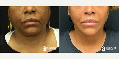 55-64 year old woman treated with AccuTite - This patient had concerns of heaviness in the lower face, neck and chin area. She underwent Accutite to the lower face and neck to reduce facial volume and define the jawline. Patient also received Botox to the masseters for additional facial slimming. After photo is 10 months post procedure.