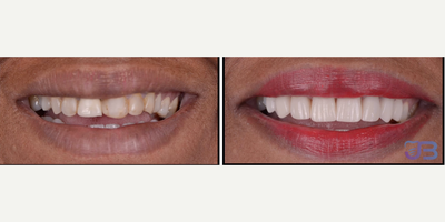 Woman treated with Dental Crown - Porcelain Veneers and Dental Crowns combination was necessary to improve this beautiful lady.