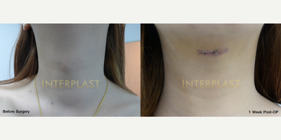 18-24 year old transgender woman treated with Adam's Apple Reduction - Adam's Apple Reduction