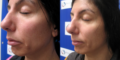 35-44 year old woman treated with IPL - Before and after 3 months. IPL for color enhancement, redness and mild sun damage
