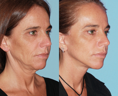 Facelift - Patient underwent a facelift