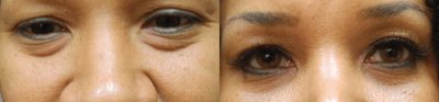 Woman treated with Eyelid Surgery - Woman treated with Eyelid Surgery