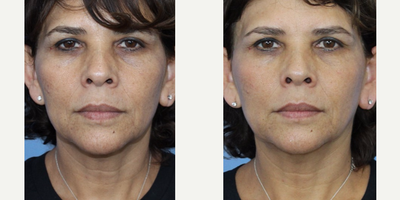 55-64 year old woman treated with Venus Freeze (1 treatment thus far) - 55-64 year old woman treated with Venus Freeze (1 treatment thus far)