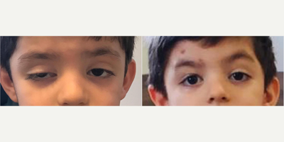 17 or under year old man treated with Ptosis Surgery, Eyelid Surgery - Congenital ptosis is not a cosmetic problem if eyelid occludes the pupil and leads to amblyopia. It should be operated at the earliest period to prevent permanent visual loss due to amblyopia.