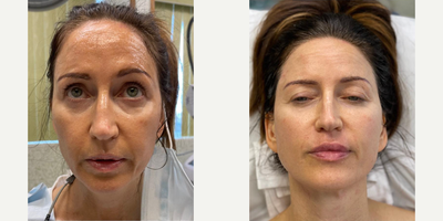 Woman treated with Liquid Facelift, Nonsurgical Facelift, Ultherapy, Thermage, Lip Fillers, Dermal Fillers - Liquid non-surgical facelift & eye-lift with Ultherapy, Thermage FLX & various fillers.