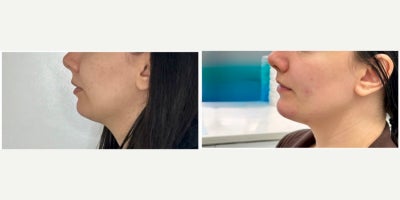 25-34 year old woman treated with Chin Filler - Patient was treated with hyaluronic acid filler to the chin to add shape and projection to the lower face. Results are immediate. Done by RN Cindy